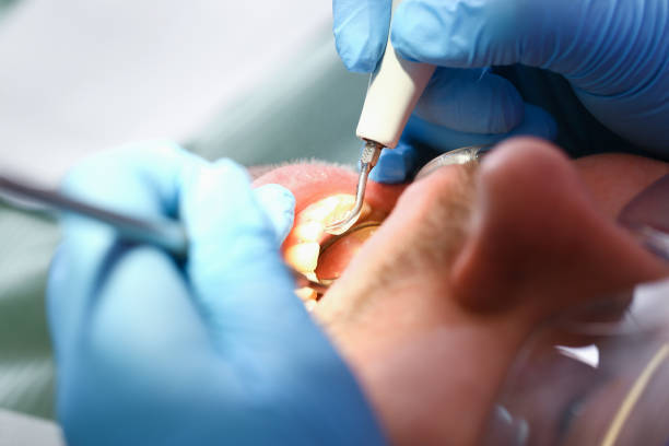Best Emergency Root Canal Treatment in Wardsville, MO