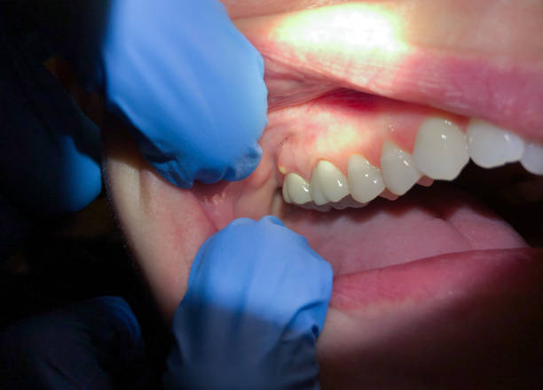 Best Emergency Dental Extractions in Wardsville, MO